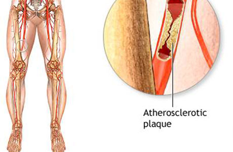 Peripheral Artery Disease